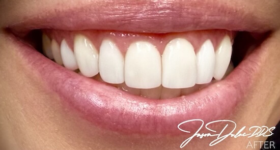 Cosmetic Veneers After