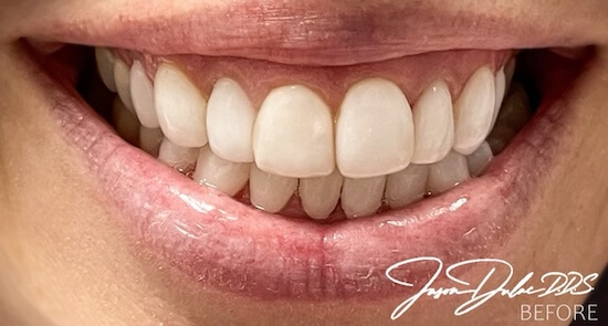 Cosmetic Veneers Before