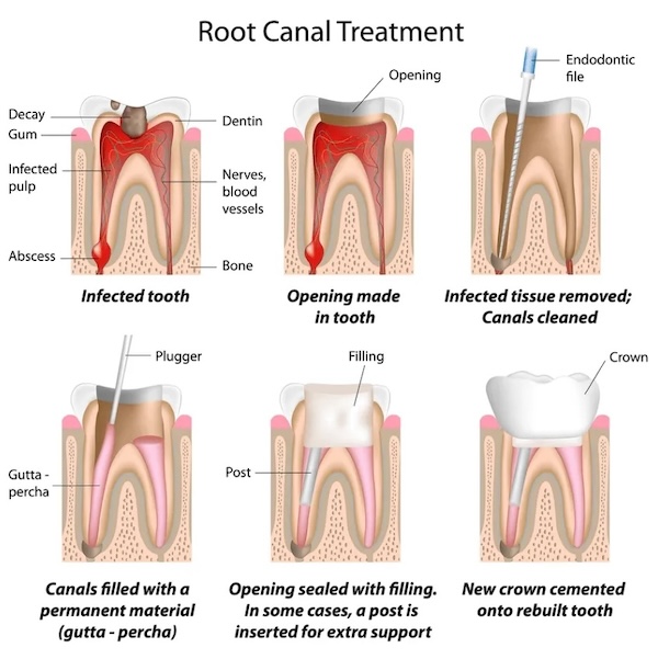 Root canal