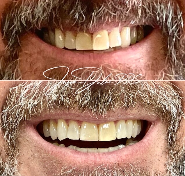 Invisalign 